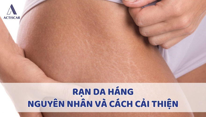 Rạn da ở háng nguyên nhân và cách xử lý
