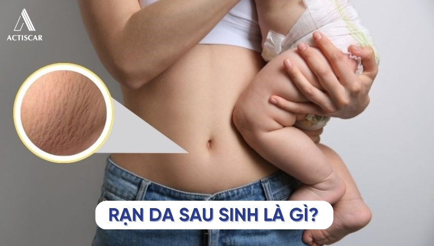 Rạn da là gì, vì sao rạn da lại khó chữa