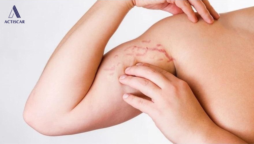 Rạn da ở bắp tay có thể tự hết hay không