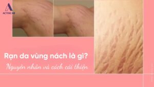 Rạn da ở nách là gì? Cách cải thiện hiệu quả