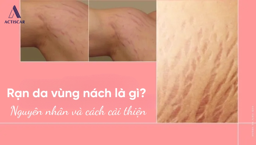 Rạn da ở nách là gì? Cách cải thiện hiệu quả