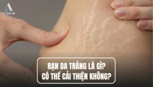 Rạn da trắng có thể điều trị được hay không