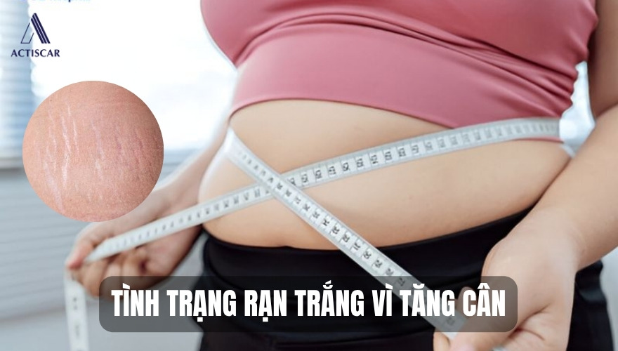 Rạn da trắng khi tăng cân