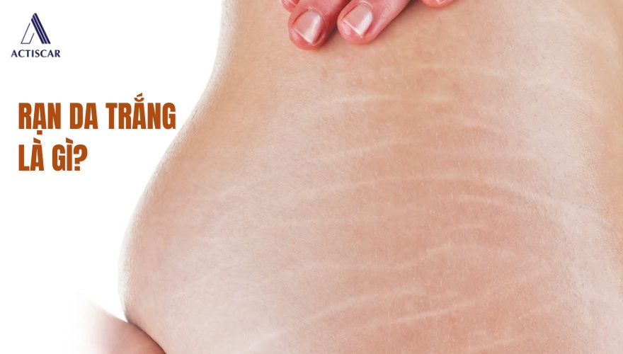 Rạn da trắng là gì? Nguyên nhân của rạn trắng