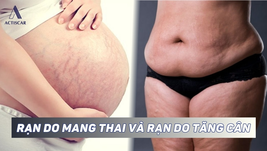 Rạn da vì tăng cân khác rạn da vì mang thai không