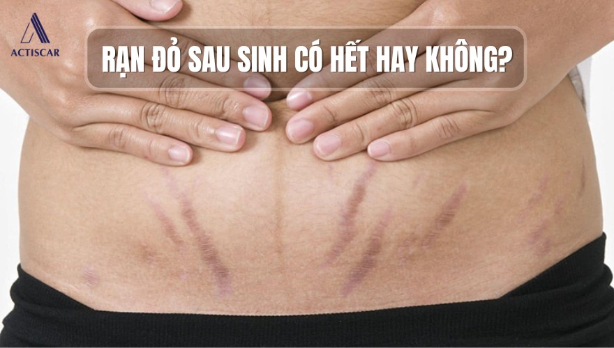 Tình trạng rạn đỏ sau sinh có hết không