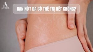 Rạn nứt da có thể điều trị được không