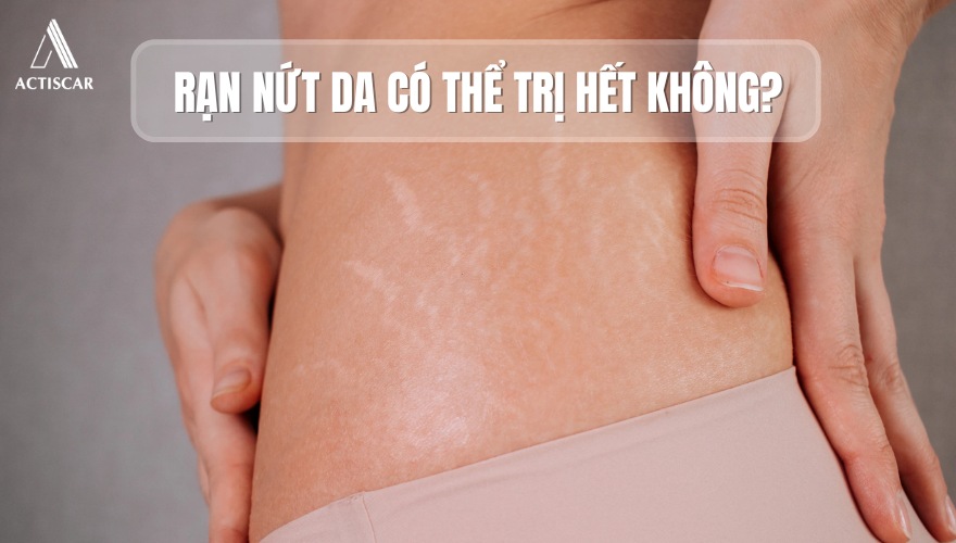 Rạn nứt da có thể điều trị được không
