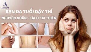 Rạn da tuổi dậy thì, nguyên nhân cách khắc phục