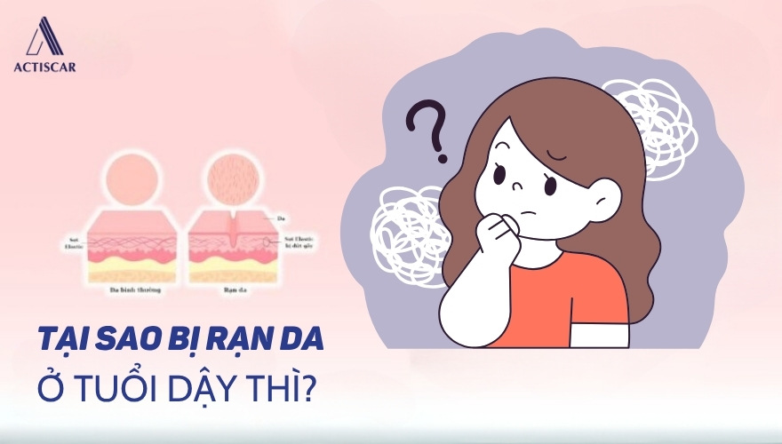 Tại sao tuổi dậy thì lại xuất hiện rạn da mông