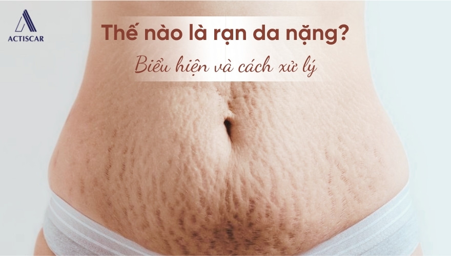 Thế nào là tình trạng rạn da nặng?