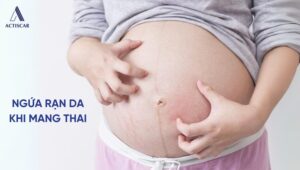 Tình trạng ngứa rạn da khi mang thai ở mẹ bầu