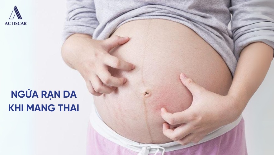 Tình trạng ngứa rạn da khi mang thai ở mẹ bầu