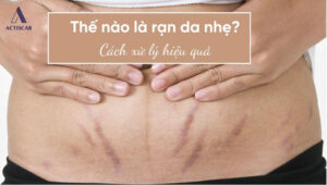 Tình trạng rạn da nhẹ là gì?