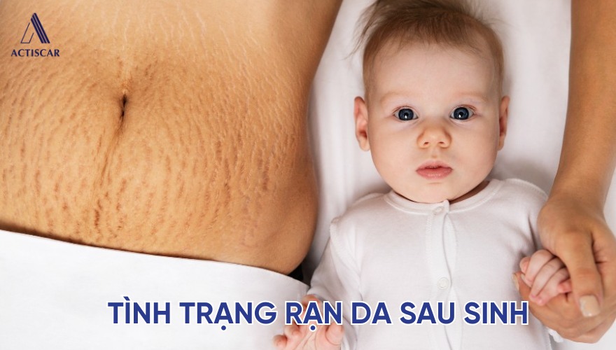 Tình trạng rạn da sau sinh khiến mẹ tự ti