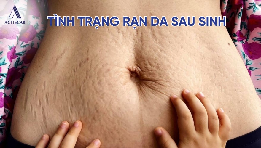 Tình trạng rạn da sau sinh
