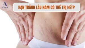Tình trạng rạn da trắng lâu năm có hết được không