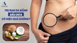 Trị rạn da bằng dầu dừa có hiệu quả