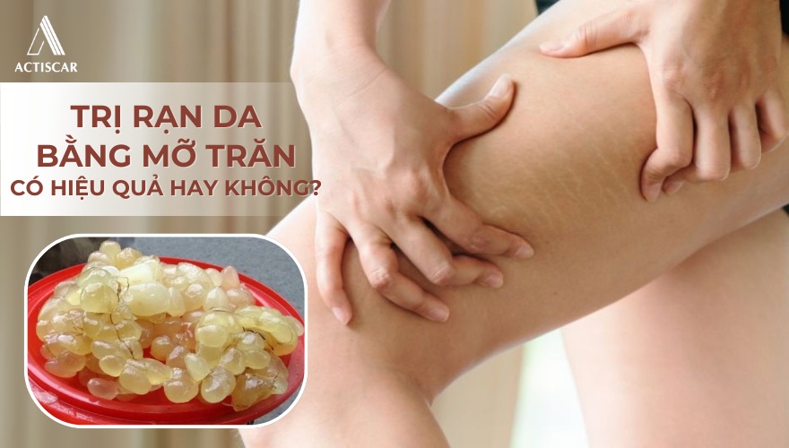 Trị rạn da bằng mỡ trăn có hiệu quả hay không
