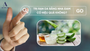 Trị rạn da bằng nha đam có hiệu quả không