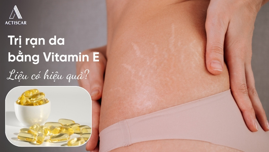 Trị rạn da bằng Vitamin E có hiệu quả hay không