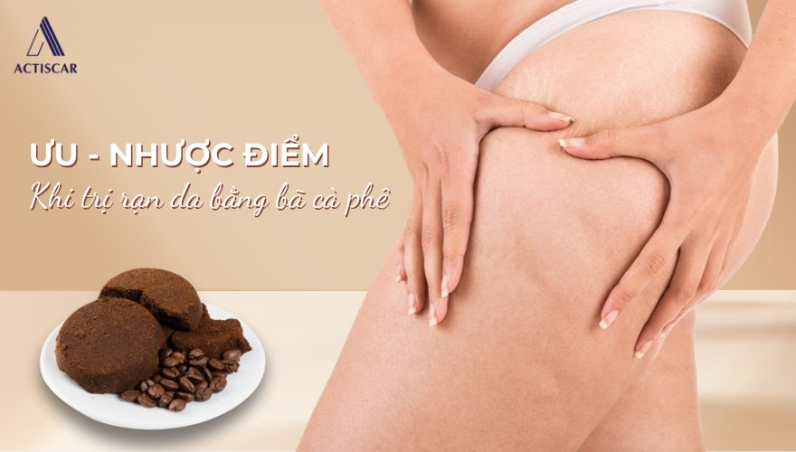 Ưu và nhược điểm khi trị rạn da bằng bã cà phê