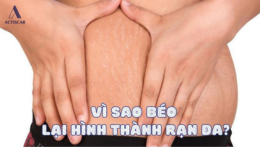 Vì sao béo quá lại hình thành rạn da