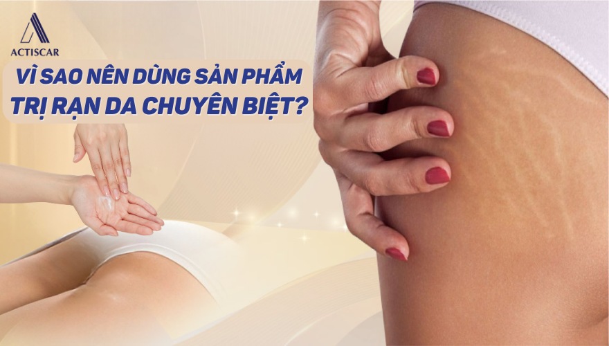 Vì sao nên sử dụng kem trị rạn da mông chuyên biệt