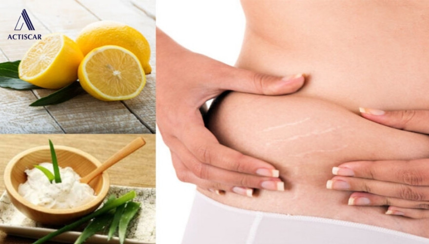 Vì sao nhiều người chọn trị rạn da tuổi dậy thì bằng chanh