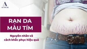 Rạn da màu tím: Nguyên nhân và cách chăm sóc
