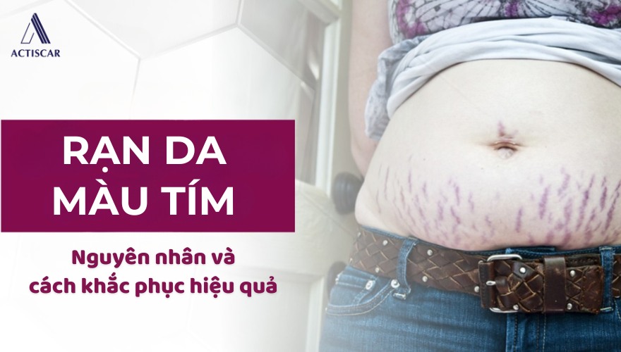 Rạn da màu tím: Nguyên nhân và cách chăm sóc