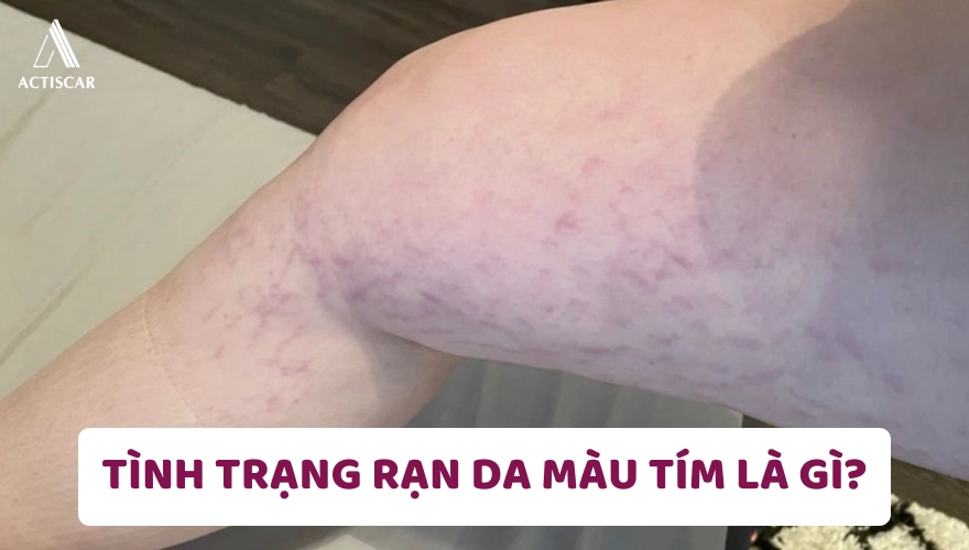 Thế nào là tình trạng rạn da màu tím