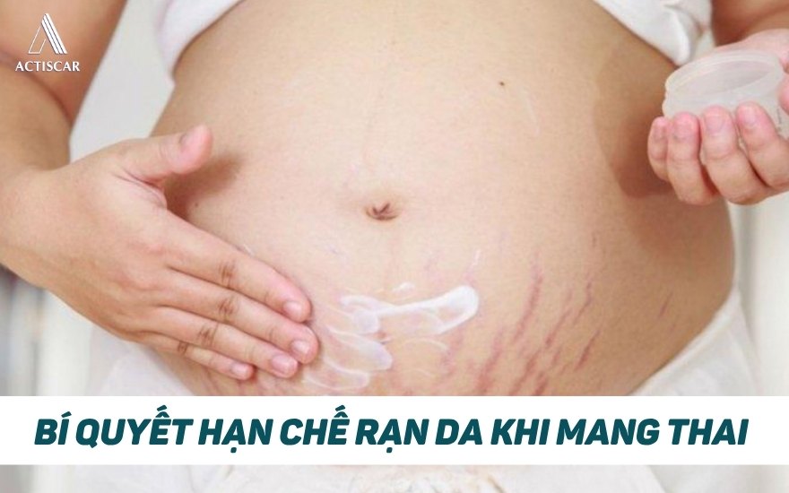 Cách giúp hạn chế rạn da khi mang thai