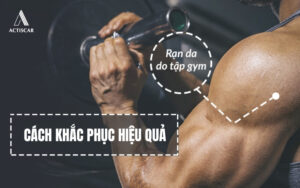 Cách khắc phục rạn da khi tập Gym