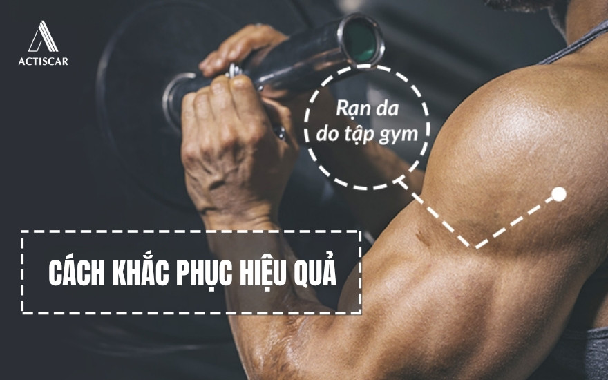 Cách khắc phục rạn da khi tập Gym