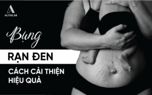 Cách xử lý bụng rạn đen sau sinh