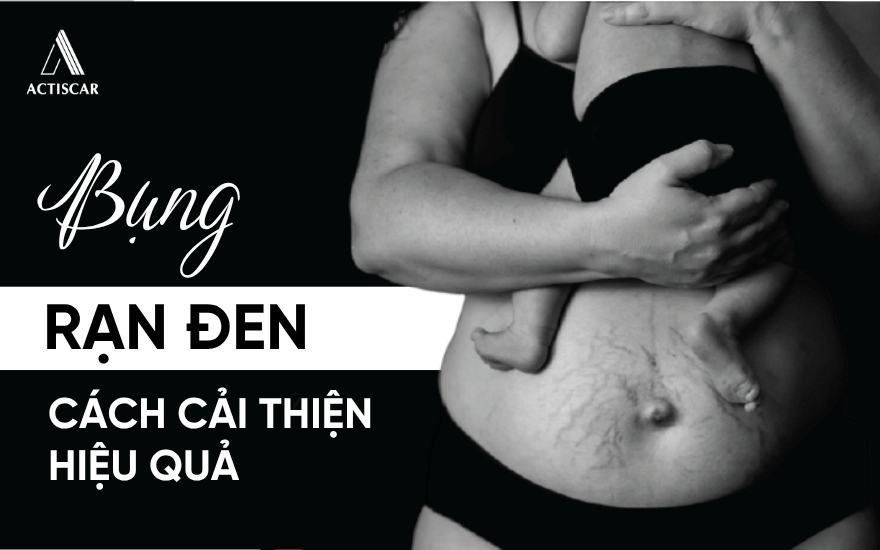 Cách xử lý bụng rạn đen sau sinh