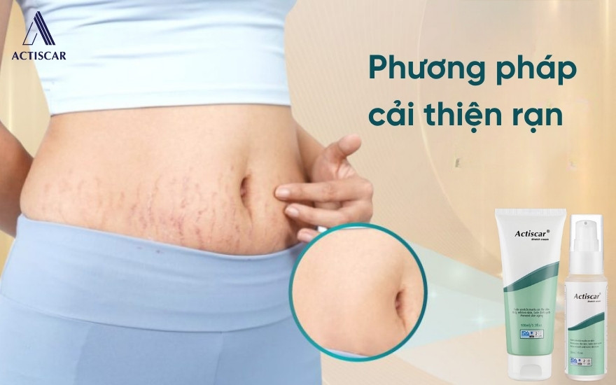 Giải pháp chăm sóc da cho người chưa sinh mà bị rạn