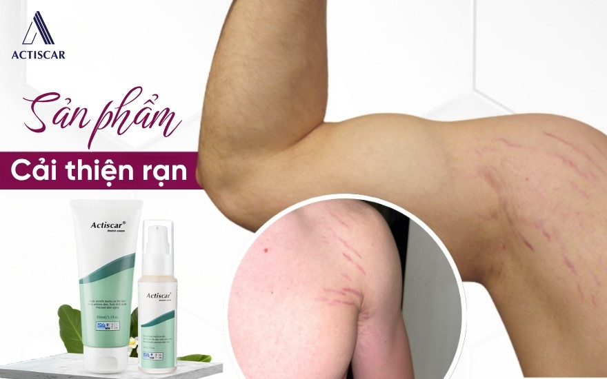 Gợi ý sản phẩm giúp cải thiện rạn da