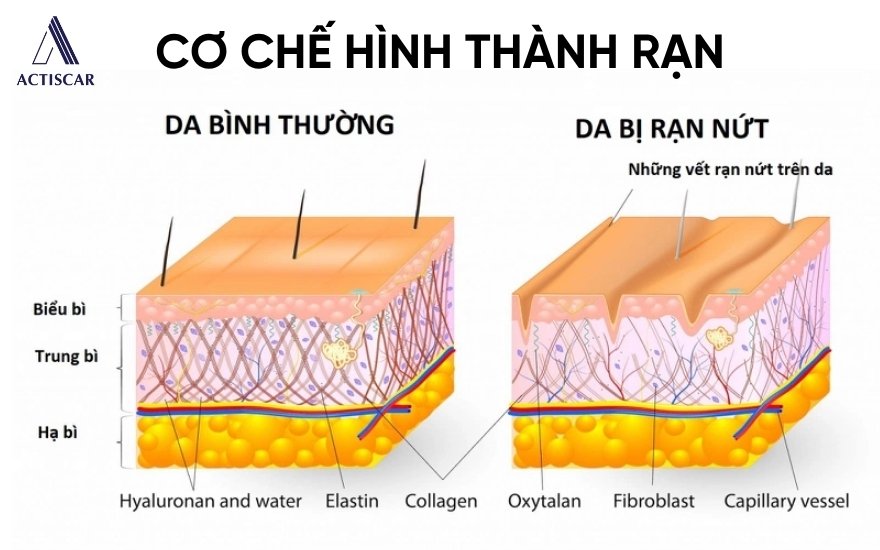Mô hình cơ chế hình thành rạn da
