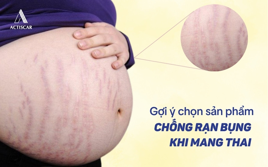 Nên chọn sản phẩm chống rạn bụng cho bà bầu