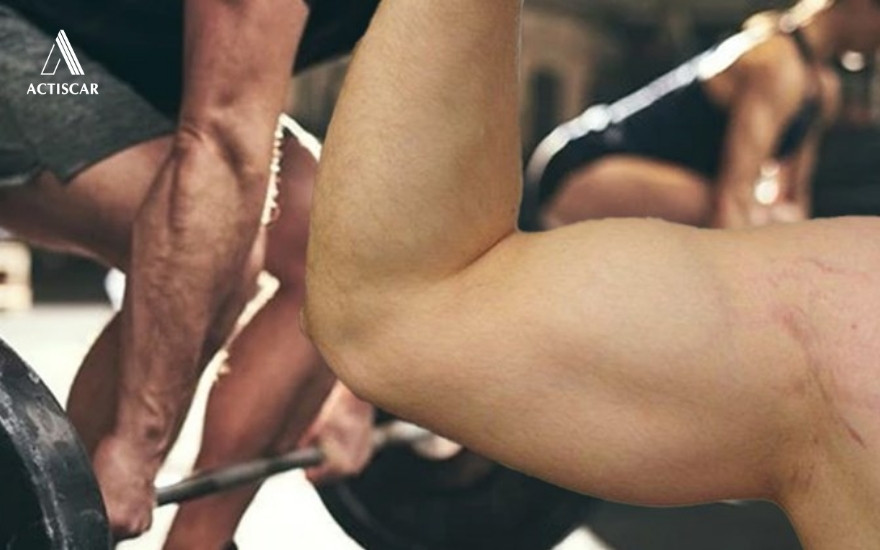 Tình trạng bị rạn da khi tập Gym là gì