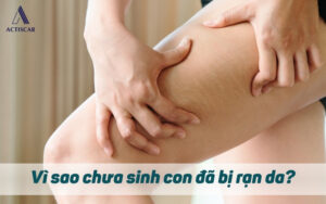 Vì sao chưa sinh con nhưng bị rạn da